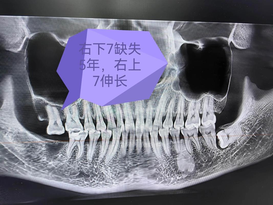 压低下前牙的有效方法有哪些？如何正确操作？-图3