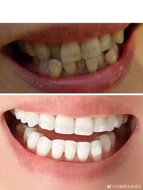 四环素牙美白，哪种方法更有效？-图3