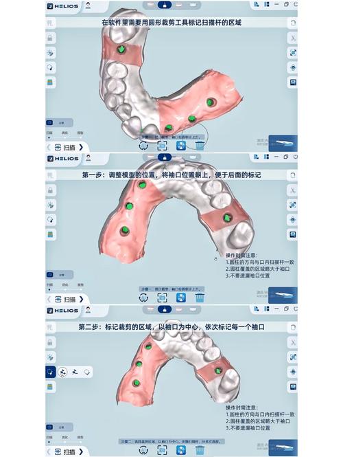 种牙是否必须做CGF?有何作用?-图3 种牙是否必须做CGF?有何作用?-图3