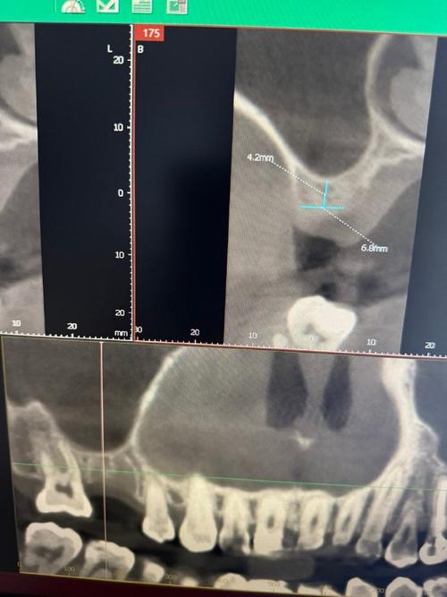 种牙CT测量数据，种植方案制定的关键依据有哪些？-图3