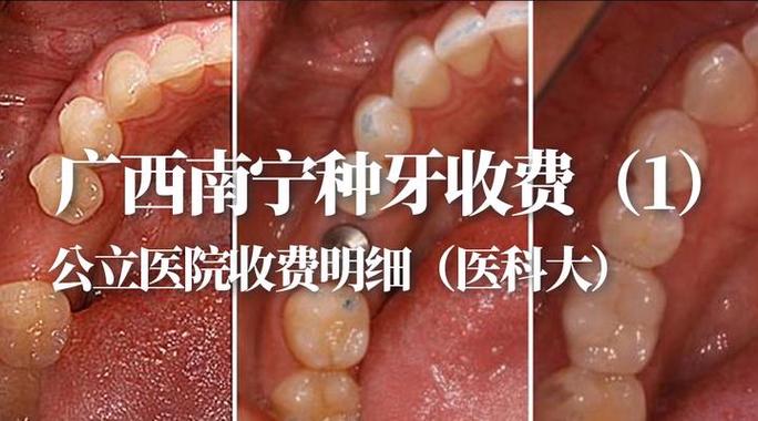 南宁哪个医院种牙靠谱？技术好收费透明哪家强？-图3