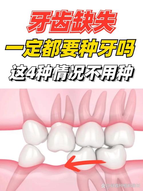 是否可以不用种牙-图1