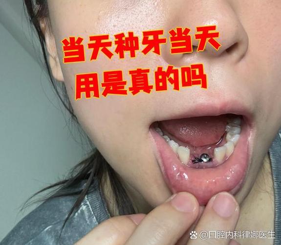 种牙真实经历分享，过程到底疼不疼效果好不好？-图1