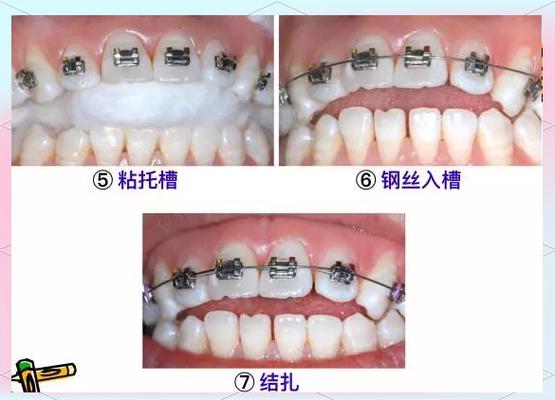 牙齿松动固定有哪些有效方法？-图1