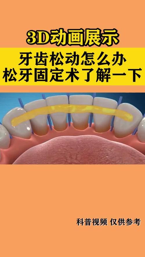 牙齿松动有哪些有效的治疗方法能帮助恢复？-图2