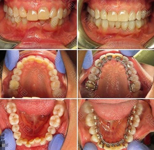 上海同济医院牙齿正畸适合哪些人？效果如何？-图3