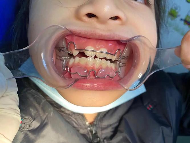 美国正畸协会为何强调儿童早期矫正的必要性？-图1