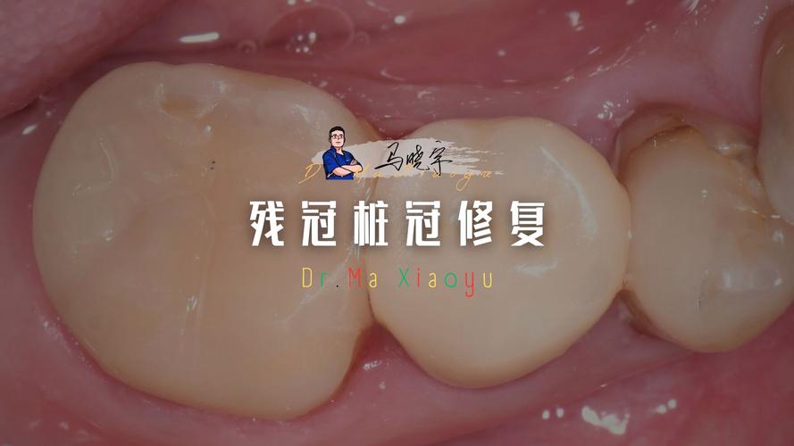 桩核冠粘接方法如何选择？关键步骤有哪些？-图3