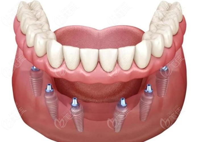 成都专业口腔种牙，如何选专业靠谱机构？-图2