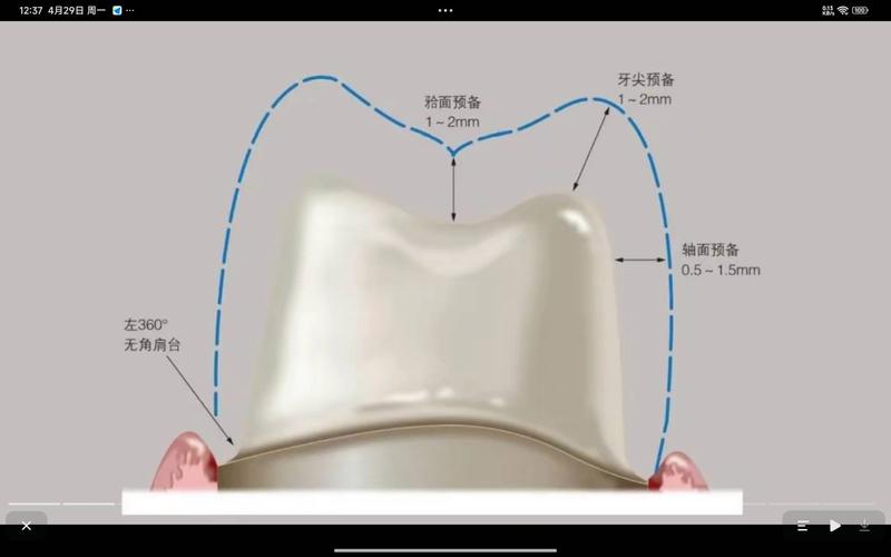 全瓷冠制作的具体步骤和技术要点是什么？-图1