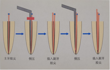 冷牙胶充填方法的关键步骤和注意事项是什么？-图2