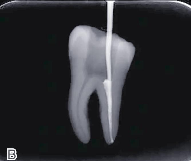 冷牙胶充填方法的关键步骤和注意事项是什么？-图3