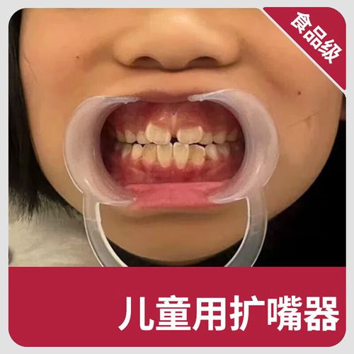 扩牙器如何正确使用？详细步骤与注意事项有哪些？-图1