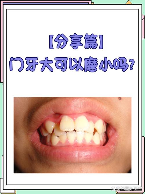 牙齿磨小有方法吗？具体如何操作？-图2