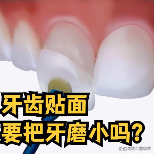 牙齿磨小有方法吗？具体如何操作？-图1