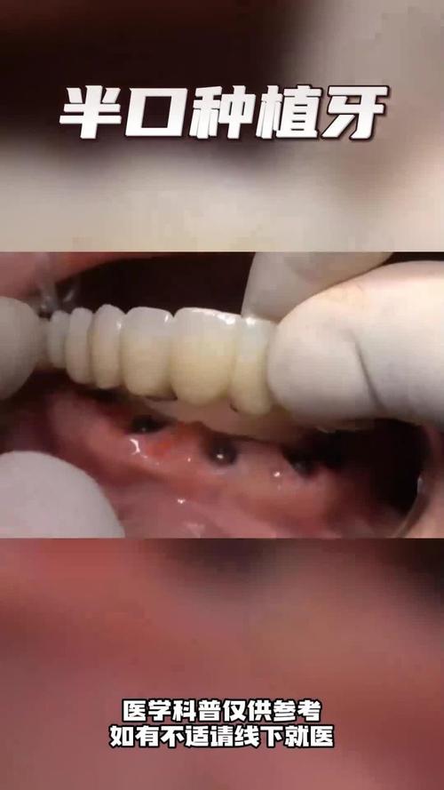 半颗门牙种牙，具体流程和注意事项有哪些？-图1