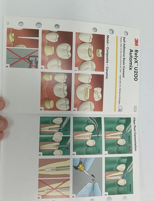 正畸附件粘结技术改进-图2