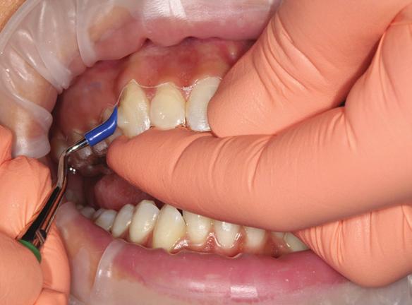 正畸附件粘结技术改进-图1