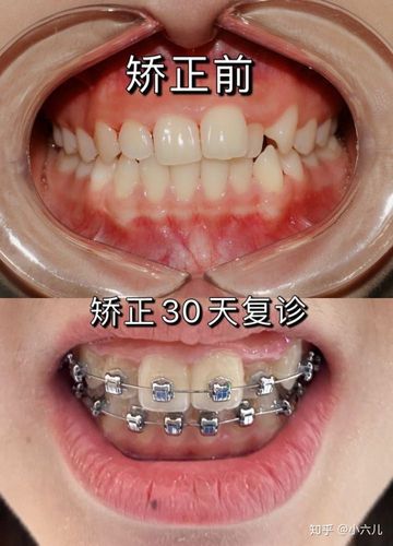 固定正畸复诊期间需监控哪些关键内容？-图2