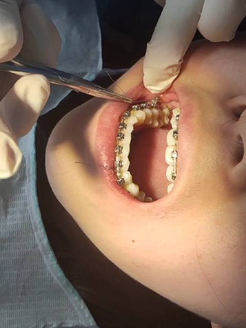 固定正畸复诊期间需监控哪些关键内容？-图3