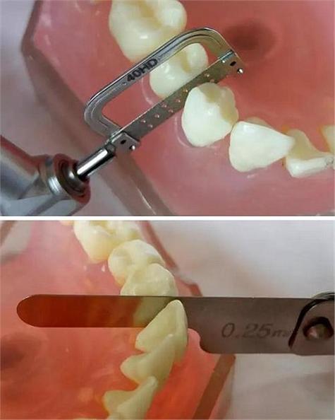 邻面去釉的方法如何规范操作及步骤？-图2