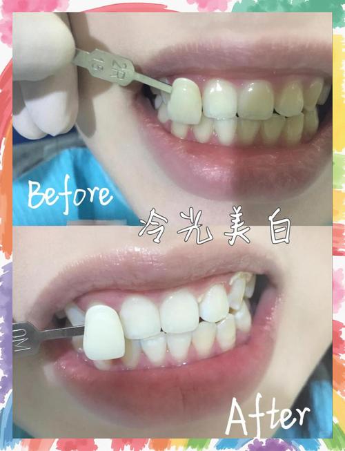 冷光美白的方法有哪些?具体步骤是怎样的?-图1 冷光美白的方法有哪些?具体步骤是怎样的?-图1