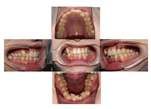 正畸口内照片患者角度-图2