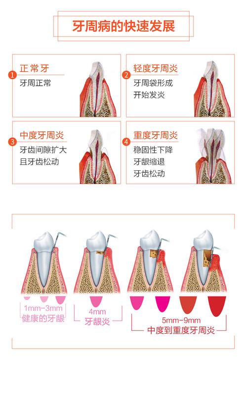 齿周病有哪些有效治疗方法？-图3
