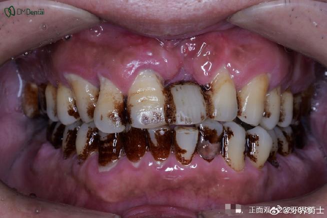 牙周炎未治直接种牙，可行吗？风险如何？-图2