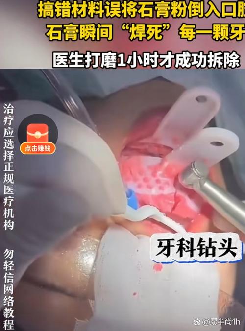 牙模灌石膏方法-图2