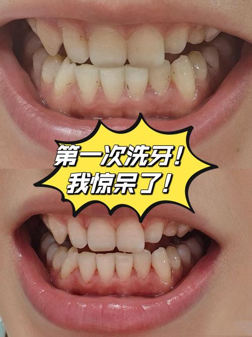 种牙期间能洗牙吗？医生提醒这几点要注意-图2