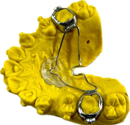 口腔正畸tpa的应用-图1