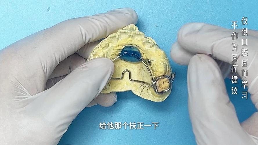 口腔正畸tpa的应用-图3