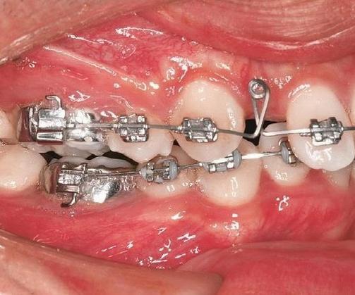 垂直张力曲正畸图片展示哪些关键矫治步骤与效果？-图3