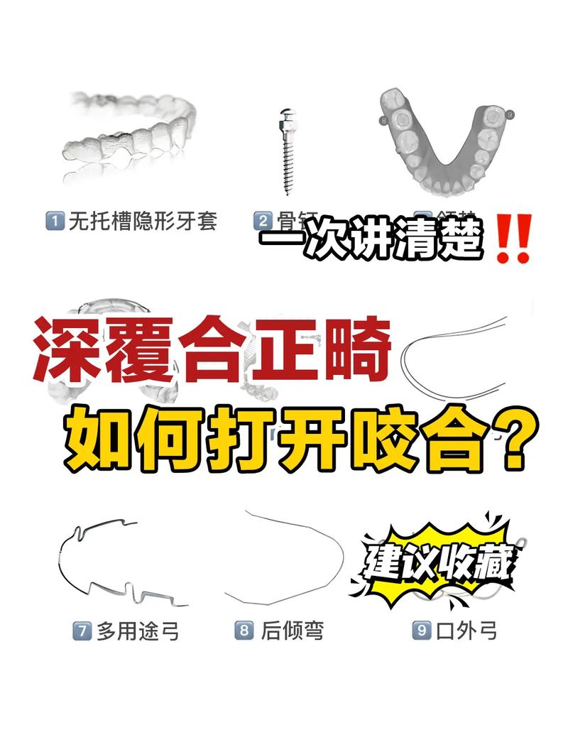 正畸打开咬合有哪些常用方法？哪种效果更好？-图3