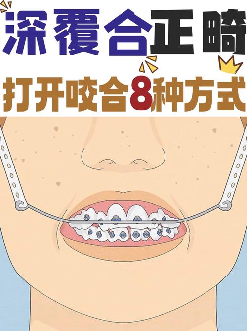 正畸打开咬合有哪些常用方法？哪种效果更好？-图1
