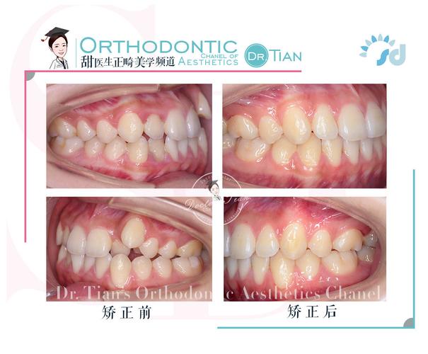 正畸过程出现牙根突出-图1