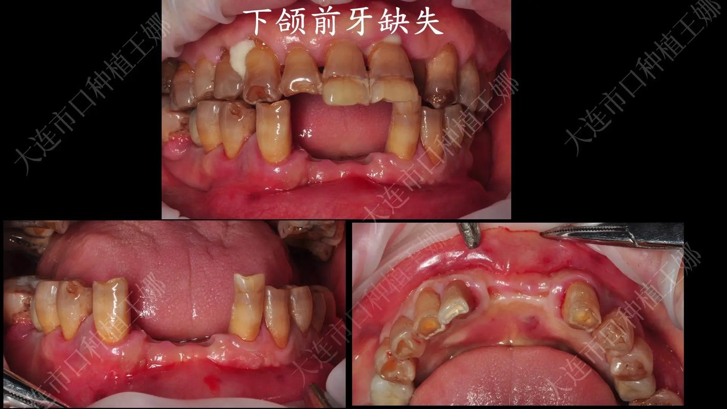 牙槽骨不够宽种牙-图3