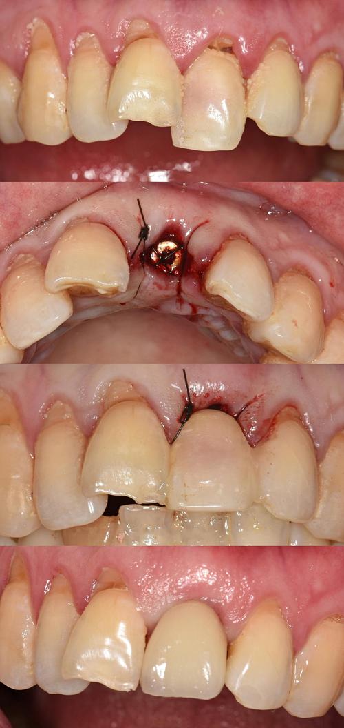 种牙后临时牙能用多久？日常护理要注意啥？-图3