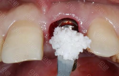 种牙为何要植入骨粉？牙脸会有影响吗？-图2