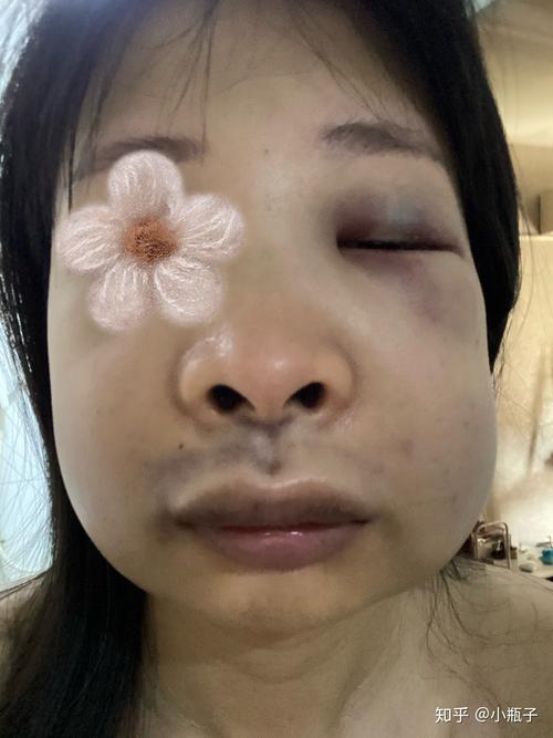 种牙为何要植入骨粉？牙脸会有影响吗？-图1