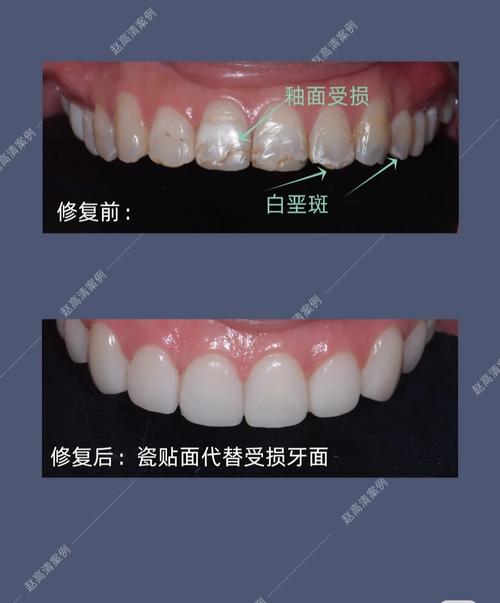 瓷贴面修复方法的关键步骤有哪些?-图1 瓷贴面修复方法的关键步骤有哪些?-图1