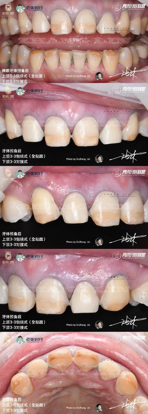 瓷贴面修复方法的关键步骤有哪些?-图3 瓷贴面修复方法的关键步骤有哪些?-图3