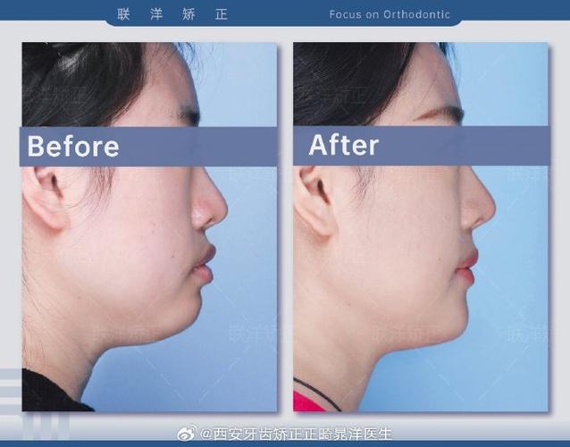 正畸真的能把智齿往前移动吗？-图3