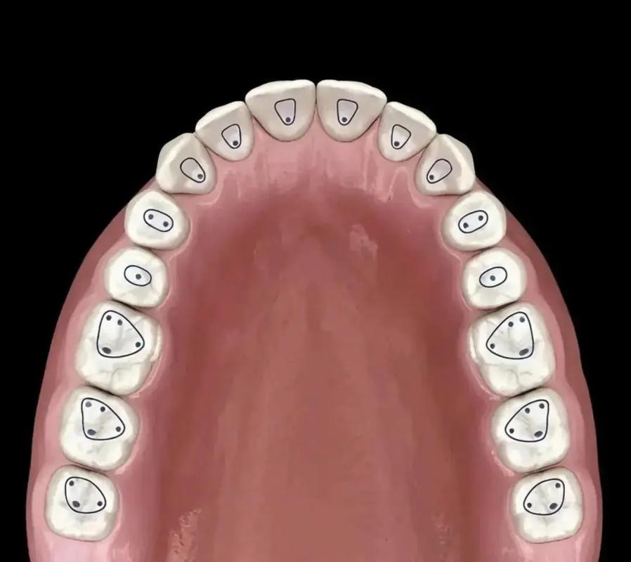 下颌第一磨牙开髓方法的关键步骤是什么？-图1