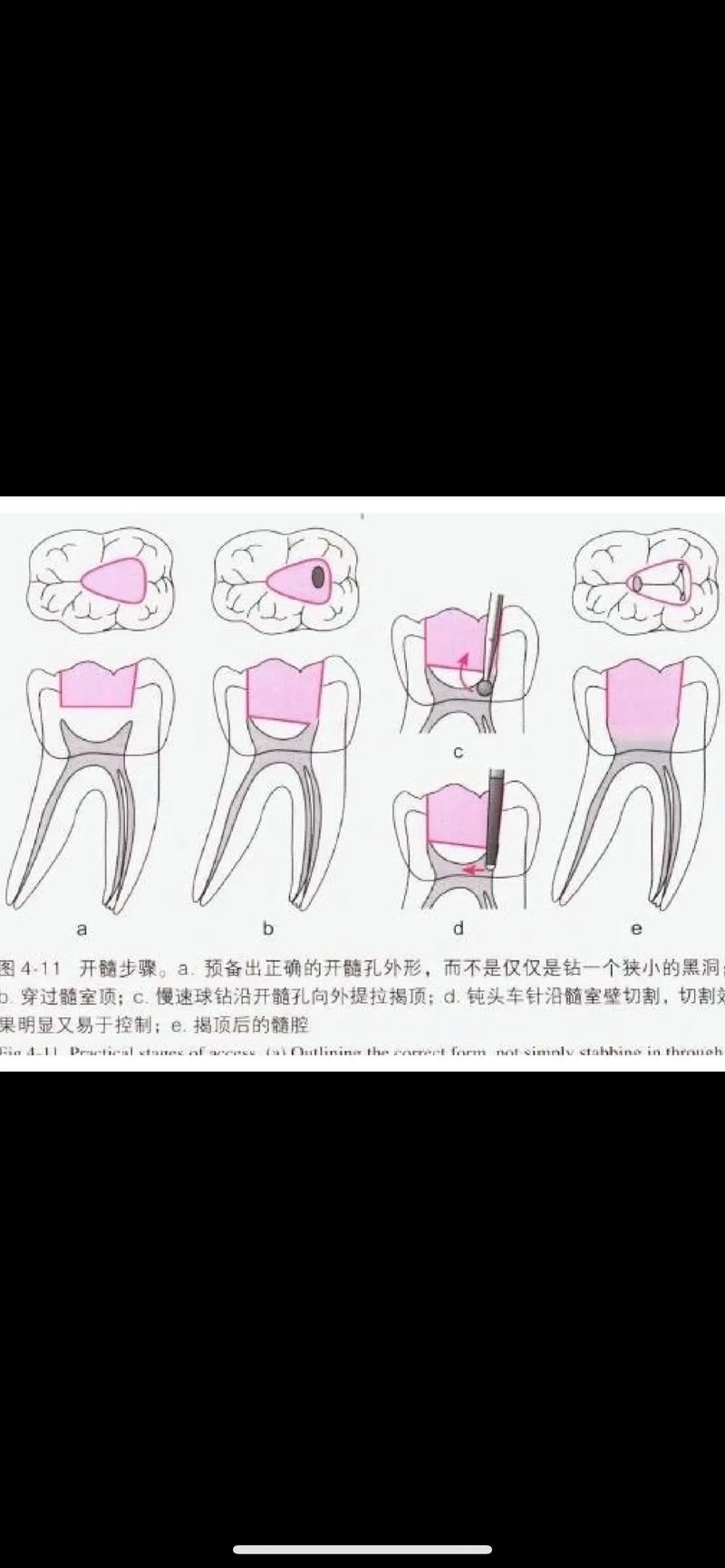 下颌第一磨牙开髓方法的关键步骤是什么？-图2