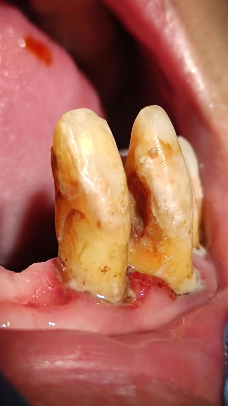 正畸后牙龈萎缩严重，如何有效处理？-图3