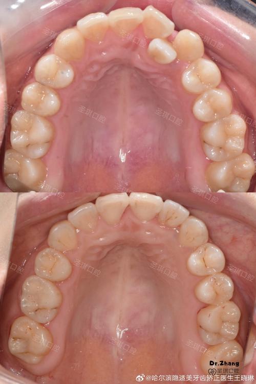 牙齿排列不齐正畸图片-图1
