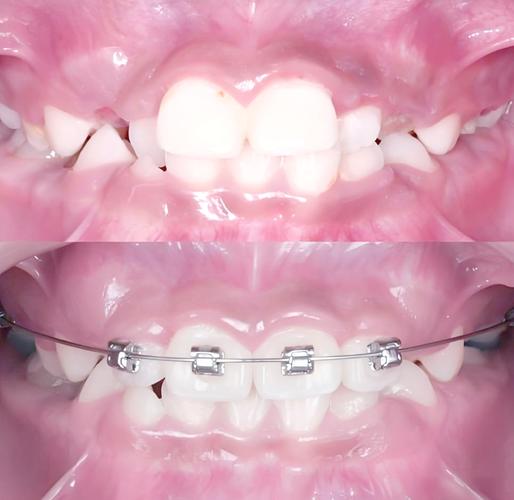 口腔正畸前方牵引图片如何帮助判断矫正效果？-图1