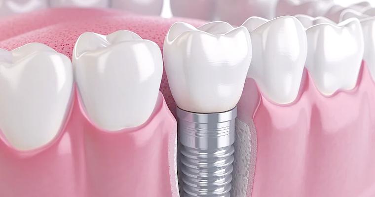 瑞士和瑞典种牙，哪个更适合？优劣势对比？-图1